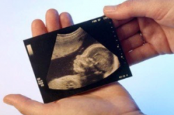У женщины на пятом месяце беременности в результате УЗИ врачи обнаружили недоразвитие плода и у него уродства. Врачи настаивают на аборте. Можно ли в этой ситуации прерывать беременность?